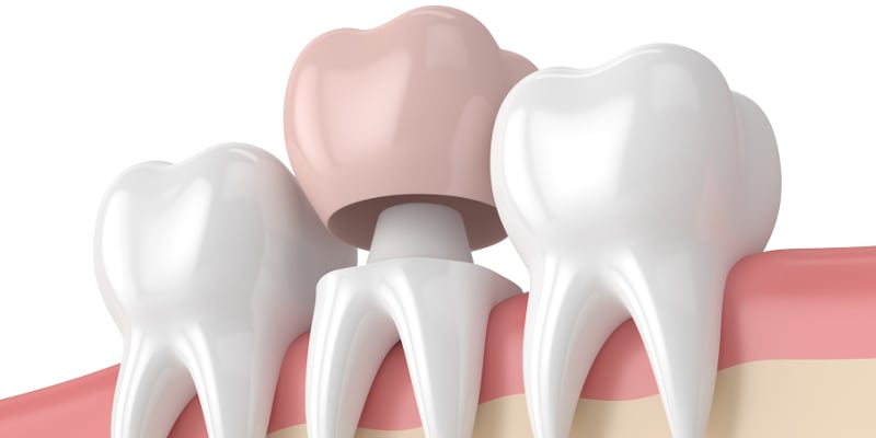 Dental Crowns in Yadkinville, North Carolina