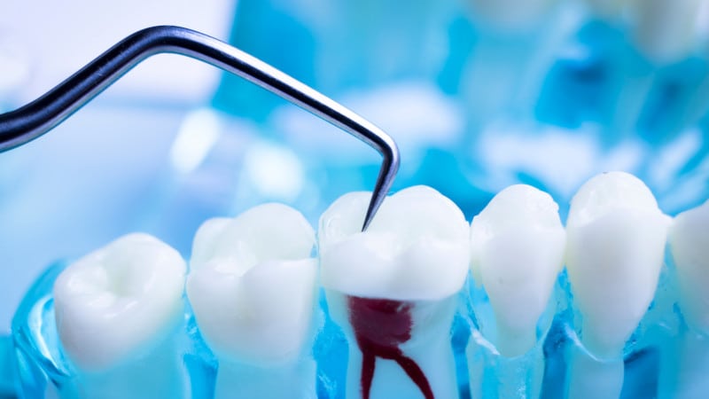 Root Canal in Clemmons, North Carolina
