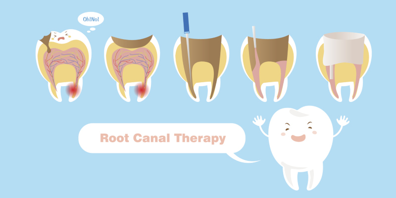 We highly recommend getting a root canal to save a tooth